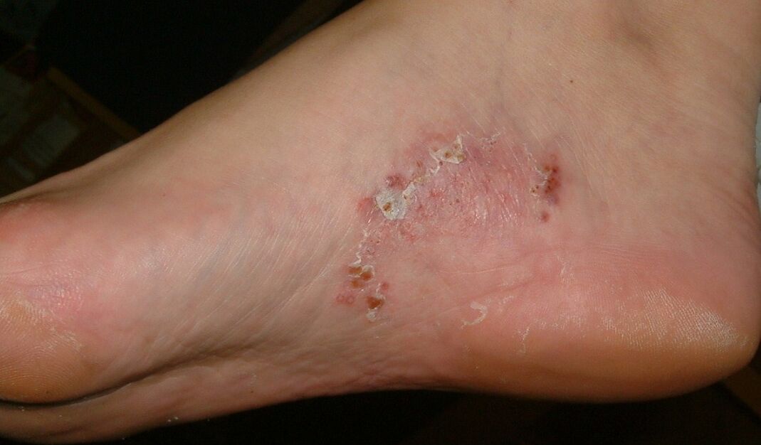 Manifestationen einer Pilzinfektion im Fuß. 
