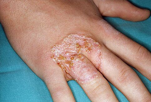 Rote kragenförmige Flecken auf der Haut der Hände aufgrund von Mykose. 
